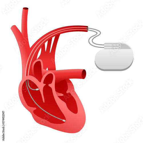 Pacemaker cardio stimulator icon (heart implant) - medical device scheme and human heart in sectional view - isolated vector surgery illustration