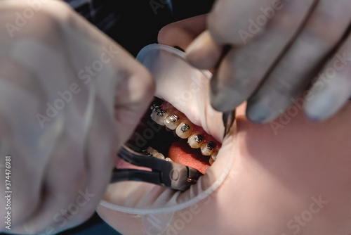 Dentist doctor installs braces system on teeth, close-up of open mouth. Health care and dental treatment concept