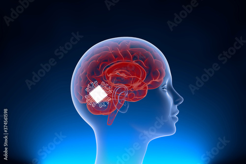 Neuralink surgically implant some computer components onto the surface of your brain to control equipments and improve the memory with neural link.  photo