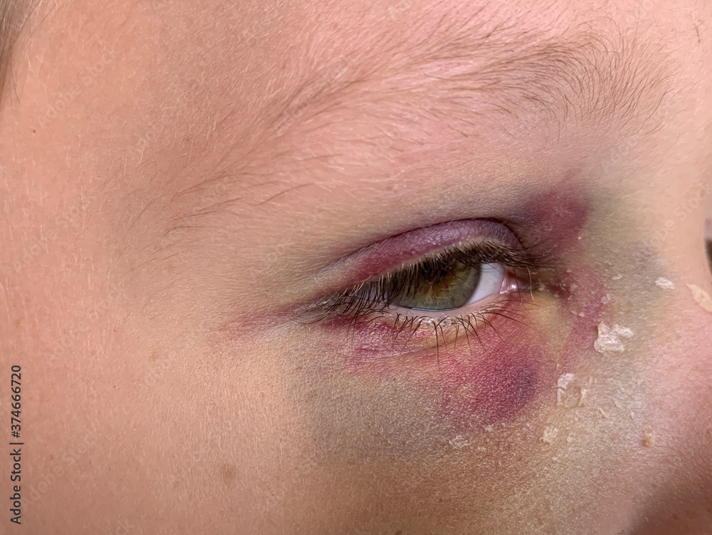 Fototapeta premium Bruise on the eye of a boy, close-up. A tumor under the eye of a teenager. Blue discoloration and himatoma on the face of a child. Concept: trauma, bodily injury.