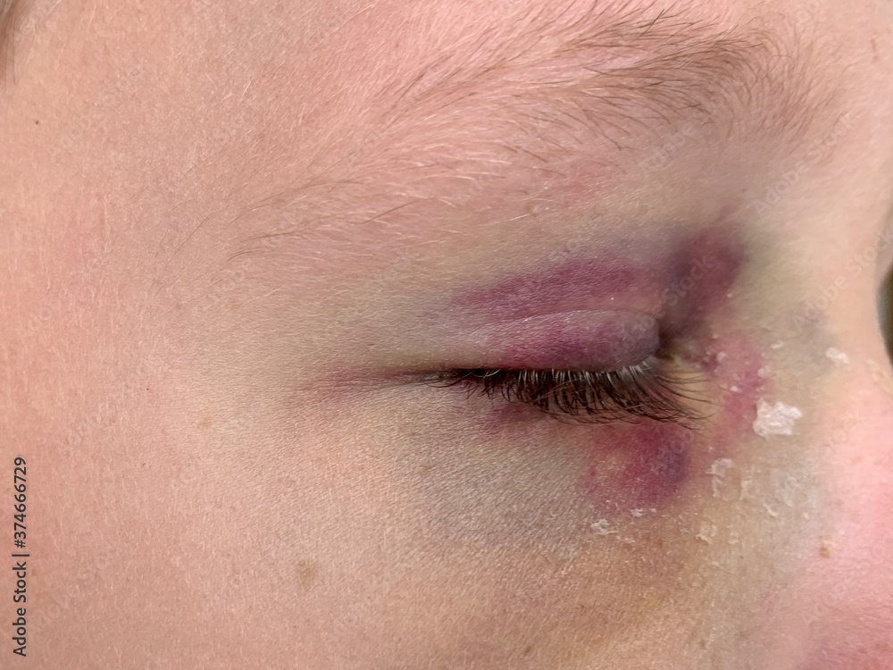 Obraz premium Bruise on the eye of a boy, close-up. A tumor under the eye of a teenager. Blue discoloration and himatoma on the face of a child. Concept: trauma, bodily injury.
