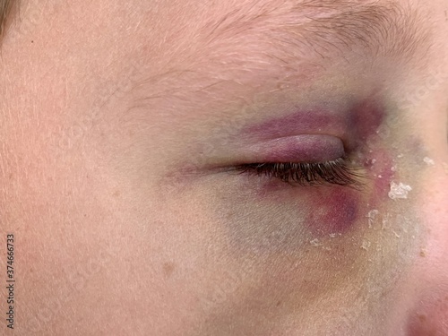 Bruise on the eye of a boy, close-up. A tumor under the eye of a teenager. Blue discoloration and himatoma on the face of a child. Concept: trauma, bodily injury.