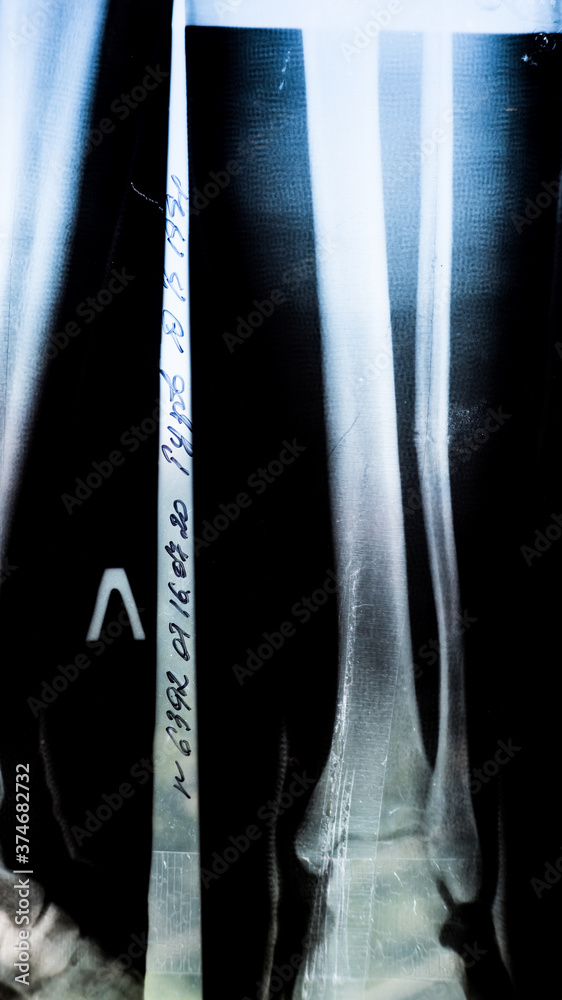 Xray of a patient with a fracture of the fibula of the middle tibia closeup in the hospital on