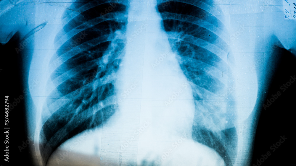 X-ray of pneumonia disease patient close up on reflective x-ray board in hospital. X-ray of pneumonia disease patient close up on reflective x-ray board in hospital.