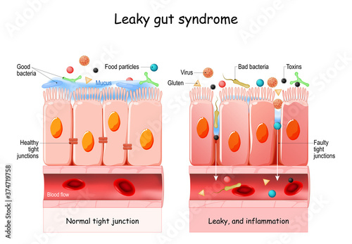 Leaky gut Syndrome photo