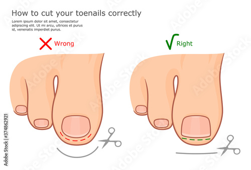 How to cut toenails correctly vector illustration. 
