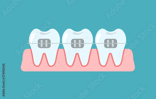 Alignment of bite of teeth, dental row  with braces,  Orthodontic, stomatology concept. Vector flat cartoon illustration