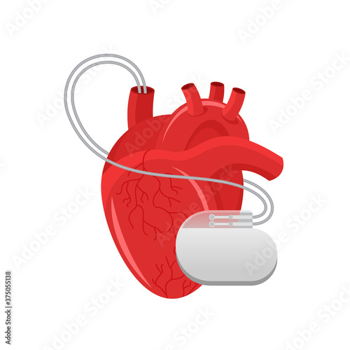 Pacemaker illustration - human heart and cardio implant - vector isolated anatomic medical picture