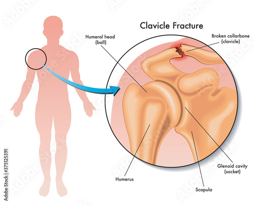 фотографія Medical illustration of a clavicle fracture and its location in the human body, with annotations