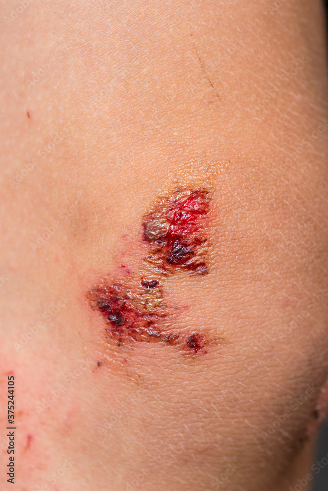 Fototapeta premium Deep scratches on the skin with bruises on the child?s knee. Wounds, scratches, abrasions on the child?s leg, knee close up