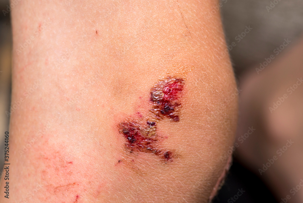 Fototapeta premium Deep scratches on the skin with bruises on the child?s knee. Wounds, scratches, abrasions on the child?s leg, knee close up