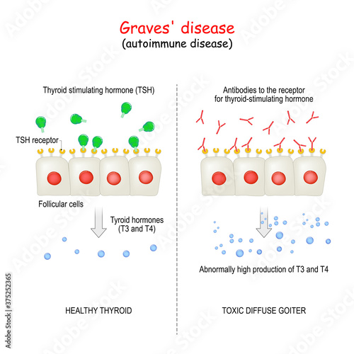 Graves' disease. autoimmune disorder.