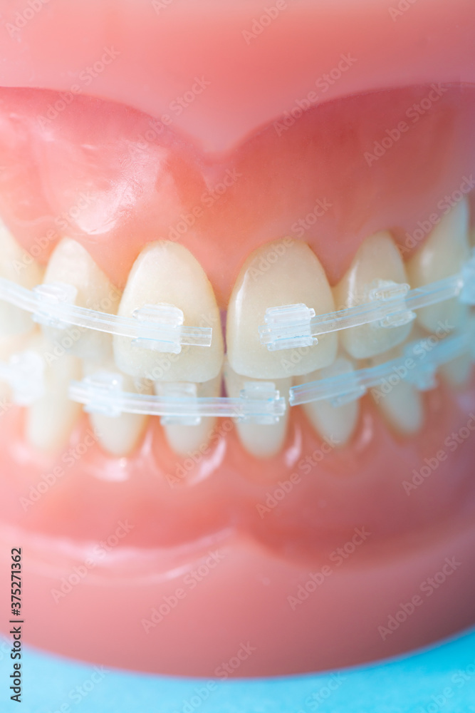 Obraz premium 歯科矯正
