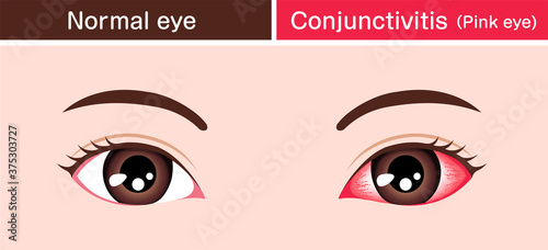 Normal eye and conjunctivitis (pink eye) vector illustration