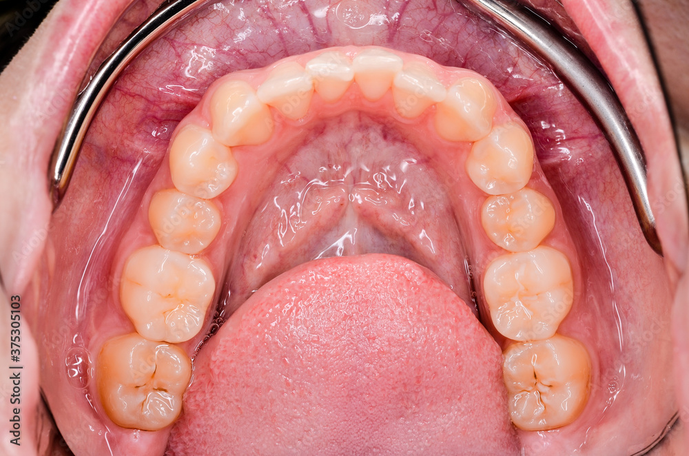 Obraz premium lower jaw after orthodontic treatment