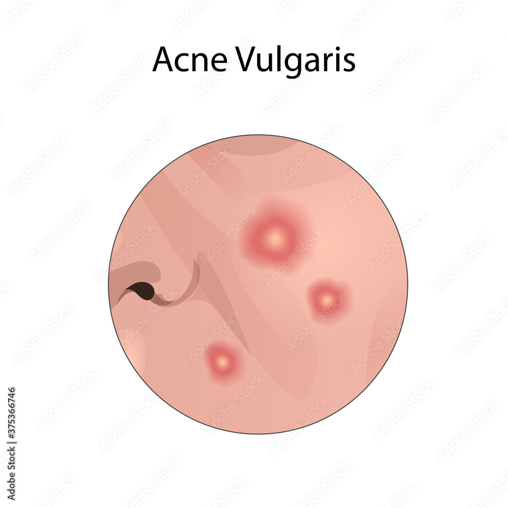 Fototapeta premium Acne vulgaris. Young woman face with skin inflammation. Close-up view.