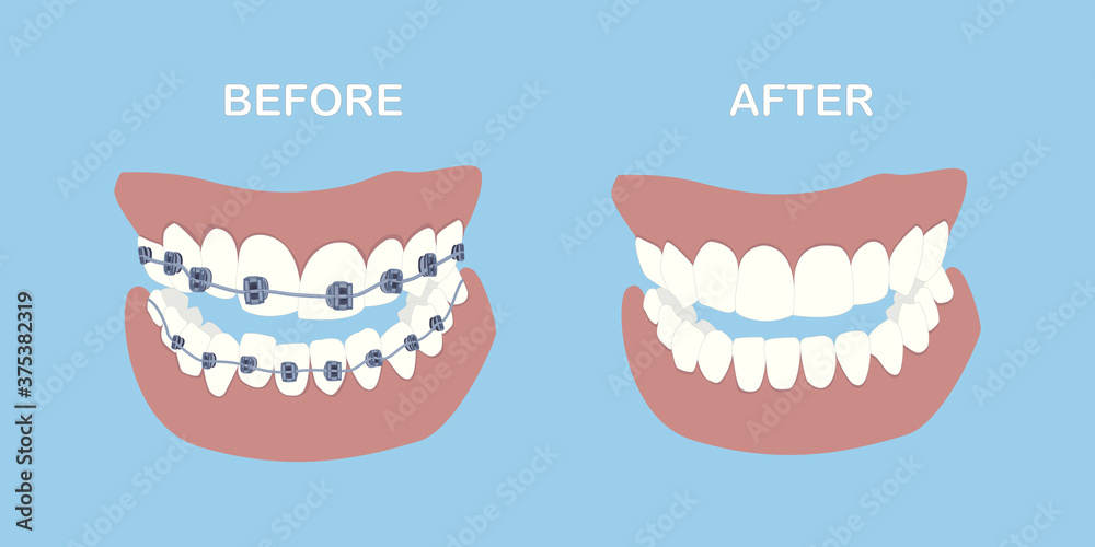 vector illustration on blue background human jaw, teeth before and after braces vector illustration on blue background human jaw, teeth before and after braces