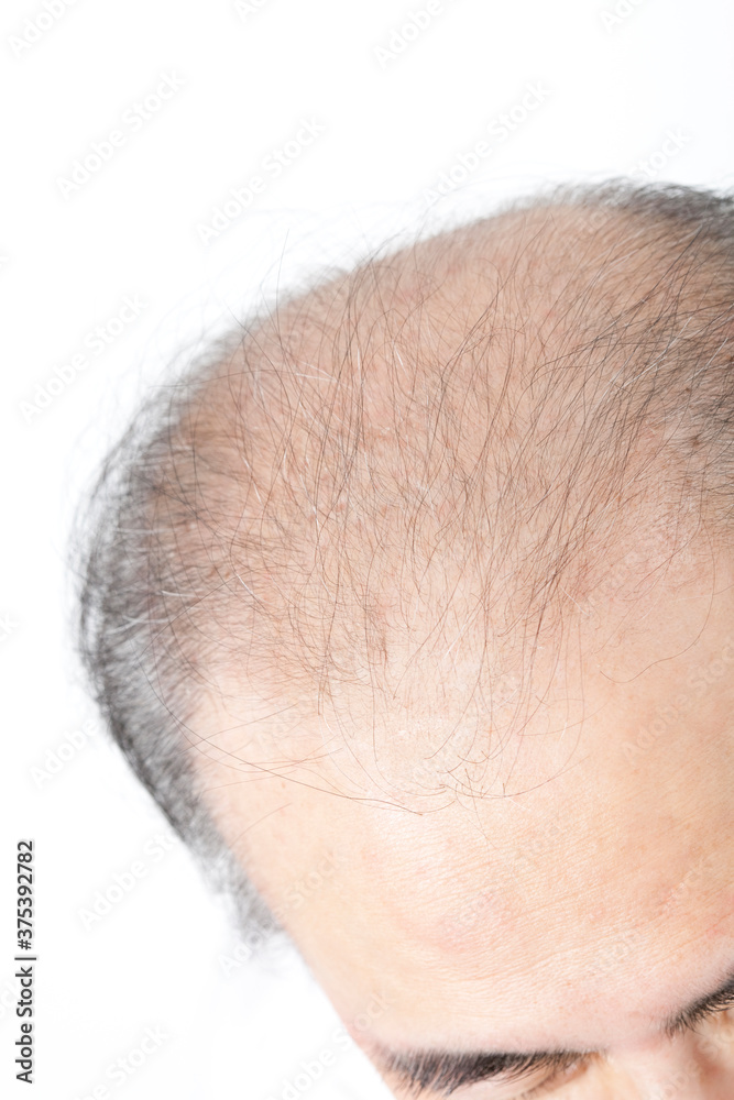 薄毛の男性 薄毛の男性