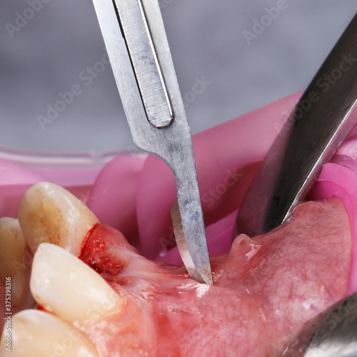 Obraz na plátně dental scalpel before gum incision for plastics and other dental procedures