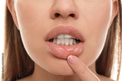 Young woman with cold sore touching lip  closeup