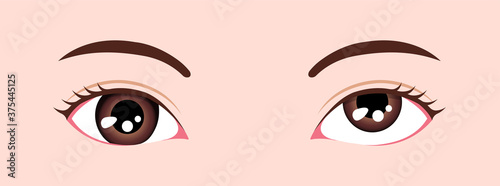 Type of strabismus vector illustration / Hypertropia