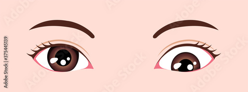 Type of strabismus vector illustration / Hypotropia photo