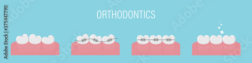The concept of teeth alignment with braces. Poster with crooked teeth, in braces and healthy even. Simple teeth in a row. Orthodontic treatment. Isolated vector illustration. Flat style