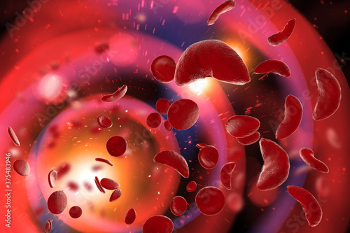 Sickle Cell Anemia 3D Illustration photo