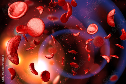Sickle Cell Anemia 3D Illustration