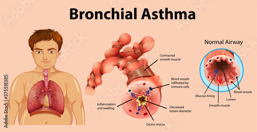 Asthma inflamed bronchial tube