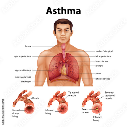 Comparison of healthy lung and Asthmatic lung
