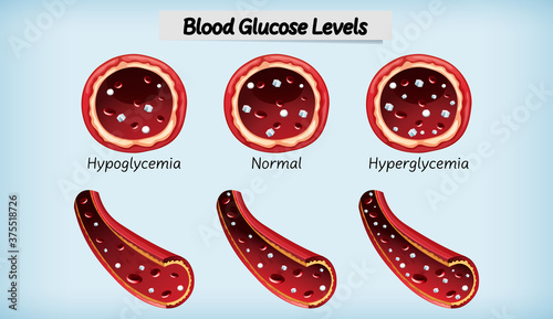 Medical blood glucose level