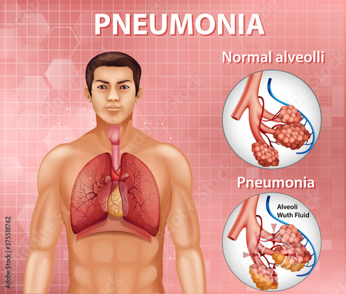 Comparison of healthy alveoli and Pneumonia