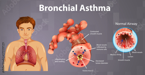 Asthma inflamed bronchial tube