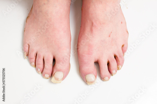 Tableau sur toile Men's unkempt feet with long uncut nails