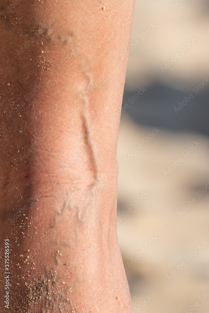 Fototapeta premium varicose veins on the male foot