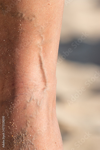 varicose veins on the male foot