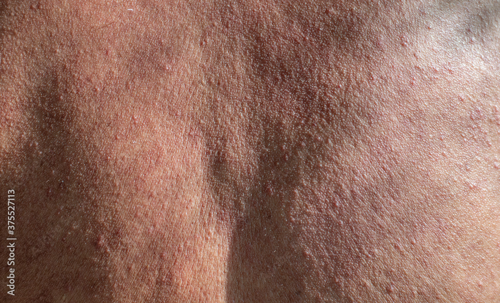 Fototapeta premium Rough skin of the back of elderly men