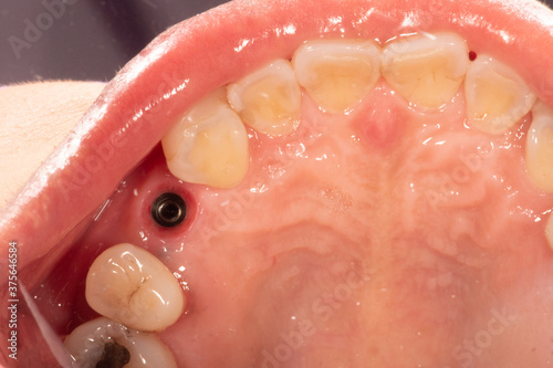 Gingival cuff after remove healing abutment from dental implant