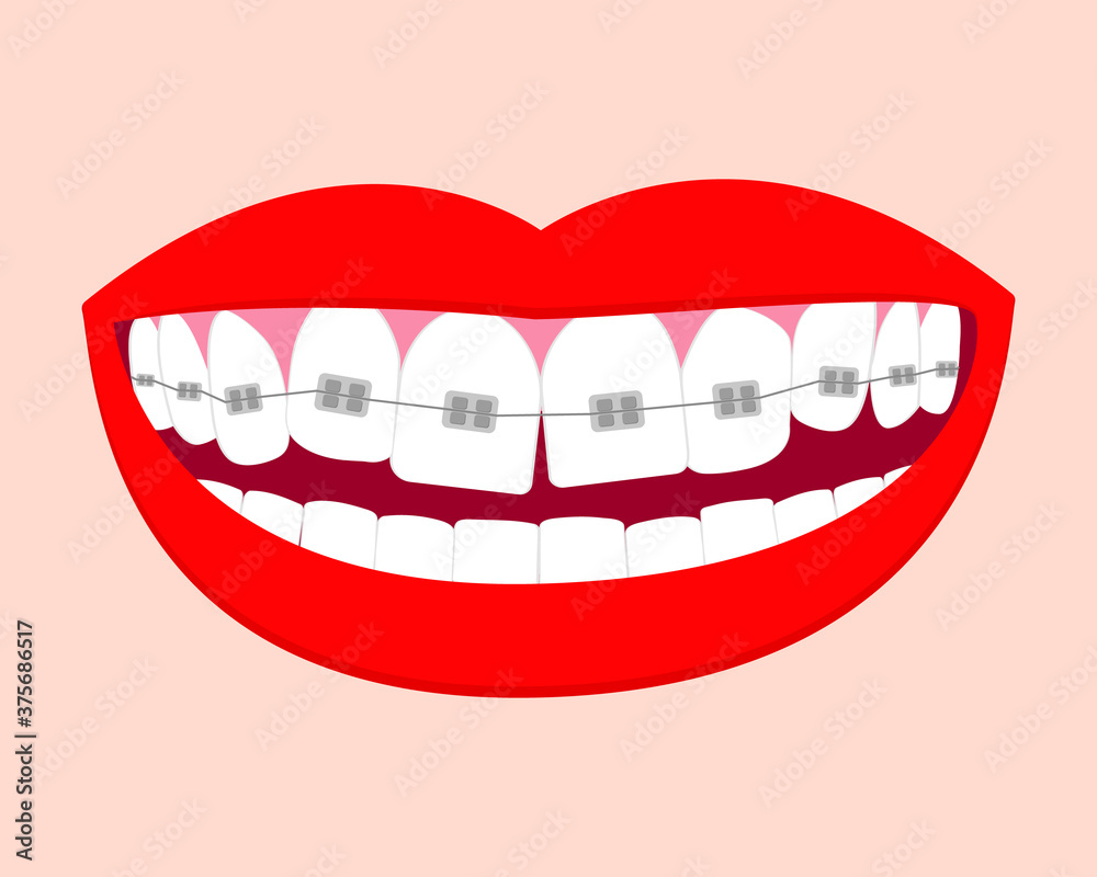 Основные Smile mouth with white teeth in braces. Vector isolated elements. EPS10RGBSmile mouth with white teeth in braces. Vector isolated elements. EPS10 Основные Smile mouth with white teeth in braces. Vector isolated elements. EPS10RGBSmile mouth with white teeth in braces. Vector isolated elements. EPS10
