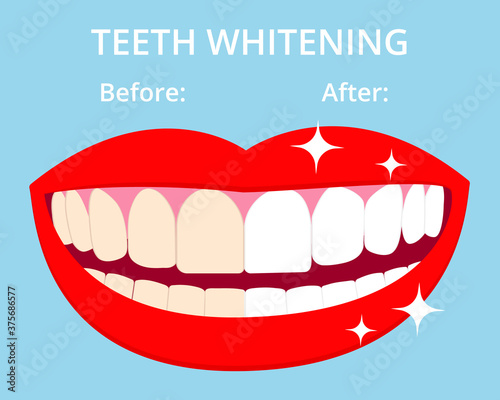 Teeth Whitening concept woth laughed mouse and teeth before and after bleaching. Vector isolated elements on blue background. EPS10