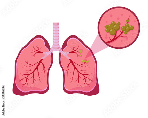 Lung cancer concept on white background.