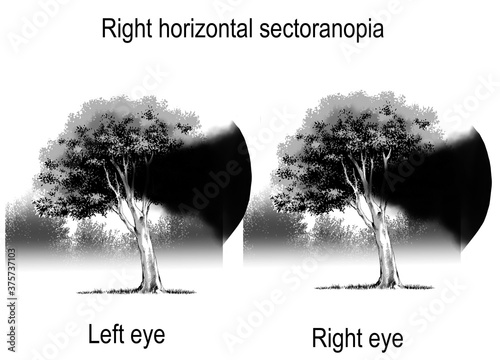 patterns of visual field defects are sign and symtomp of loss of vision which are derived from brain lesion and optic nerve lesion. photo