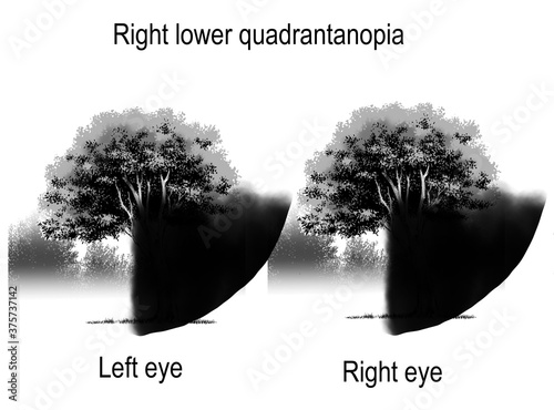 Fotografie right lower qaudrantanopia is the sign and symptom of visual field defect from brain lesion