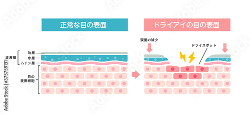 ドライアイの目・目の渇き 目の表面断面図イラスト
