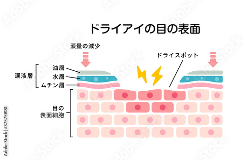 ドライアイの目の表面断面図イラスト

