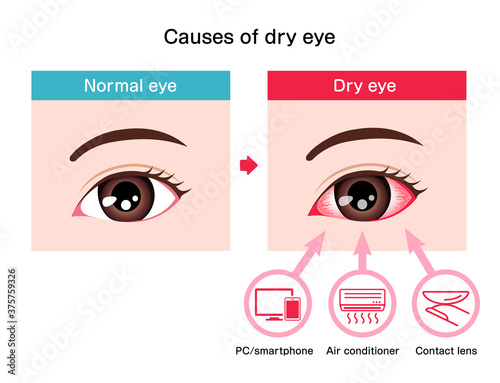 Causes of dry eye vector illustration