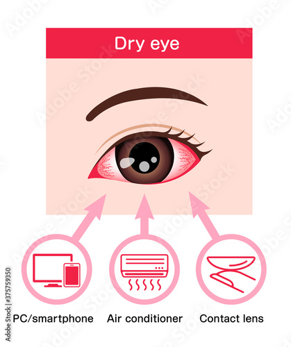 Causes of dry eye vector illustration