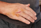 Man's hand with a cut wound, a cut hand