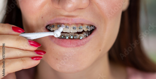 brasket system in smiling mouth, macro photo teeth, close-up lips, macro shot.